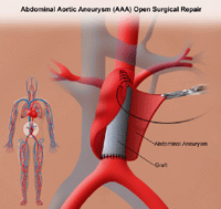target bp prior to obliteration of aneurysm