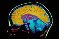 Photo of a brain MRI image