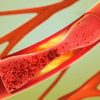 Peripheral Artery Disease Treatment Improved