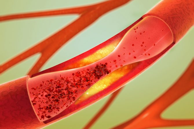 Peripheral Artery Disease Treatment Improved