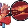 Fat in Arteries Can Worsen Cardiovascular Problems