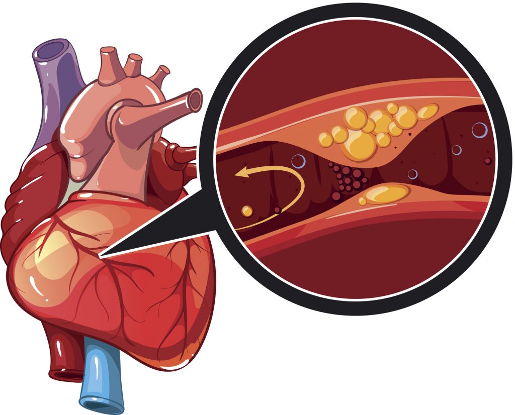 Fat In Arteries Can Worsen Cardiovascular Problems Associates In 