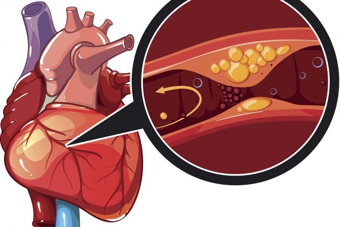 Fat in Arteries Can Worsen Cardiovascular Problems